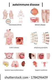 
Medical illustration to explain autoimmune diseases