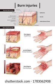 Medical Illustration Explain Burns Stock Illustration 1783062908 ...