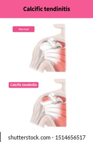 
Medical Illustration To Explain Calcific Tendinitis