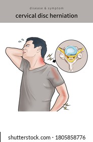 Medical Illustration For Explain Cervical Disc Herniation