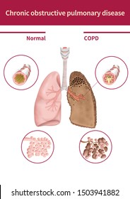 Chronic obstructive pulmonary disease Images, Stock Photos & Vectors ...