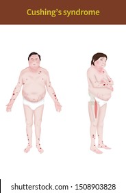 Medical Illustration To Explain Cushing Syndrome