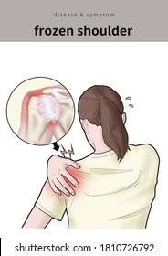 Medical Illustration To Explain Frozen Shoulder