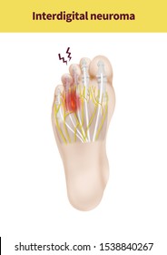 Medical Illustration Explain Interdigital Neuroma Stock Illustration ...