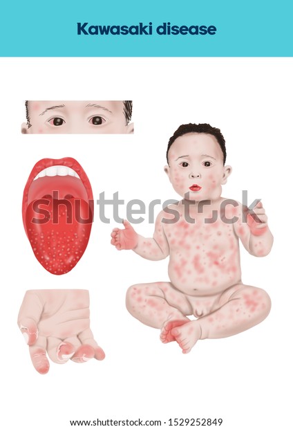 Explain Kawasaki Disease Stock-illustration 1529252849