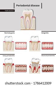 Medical Illustration Explain Periodontal Disease Stock Illustration ...