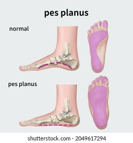 
Medical Illustration To Explain Pes Planus