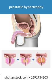 
Medical Illustration To Explain Prostatic Hypertrophy