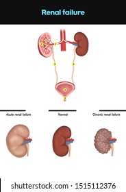 
Medical Illustration To Explain Renal Failure