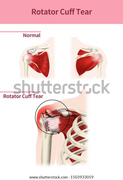 Medical Illustration Explain Rotator Cuff Tear Stock Illustration ...