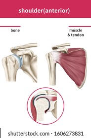 Medical Illustration Explain Rotator Cuff Tear Stock Illustration ...