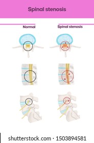 Medical Illustration To Explain Spinal Stenosis