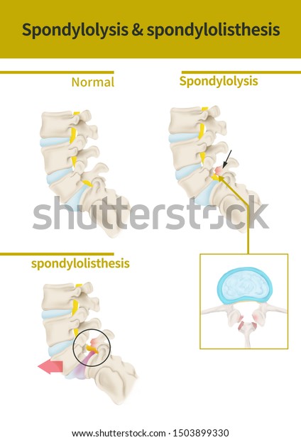 Medical Illustration Explain Spondylolysis Spondylolisthesis Stock ...