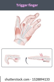 Medical Illustration To Explain Trigger Finger