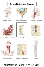 Medical Illustration Explaining Cervical Thoracic Diseases Stock ...