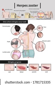 
A medical illustration explaining the characteristics of herpes zoster