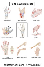 
Medical illustration explaining Hand & wrist disease