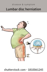 Medical Illustration For Explaining Lumbar Disc Herniation