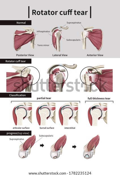 Medical Illustration Explaining Rotator Cuff Tear Stock Illustration 