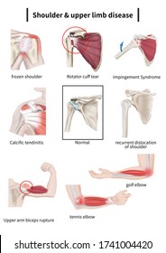 Medical Illustration Explaining Shoulder Upper Limb Stock Illustration ...