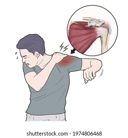 Medical Illustration For Explanation Calcific Tendinitis