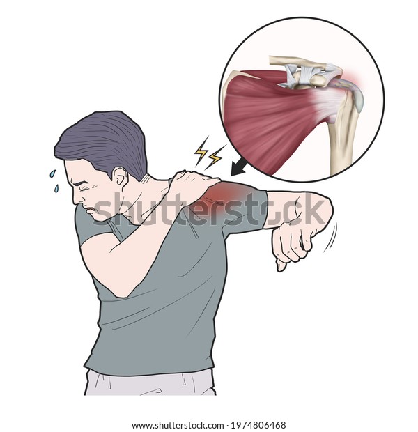 Medical Illustration Explanation Calcific Tendinitis Stock Illustration ...