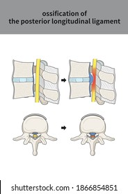 
Medical Illustration For Explanation Ossification Of The Posterior Longitudinal Ligament