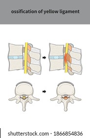 
Medical Illustration For Explanation Ossification Of Yellow Ligament