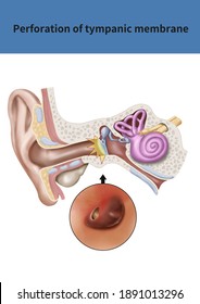 
Medical Illustration For Explanation Perforation Of Tympanic Membrane