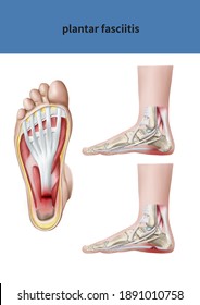 足底筋膜炎 のイラスト素材 画像 ベクター画像 Shutterstock