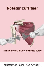 Medical Illustration For Explanation Rotator Cuff Tear