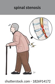 
Medical Illustration For Explanation Spinal Stenosis