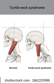 
Medical illustration for explanation Turtle neck syndrome
