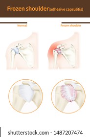 
Medical Illustration Of Frozen Shoulder