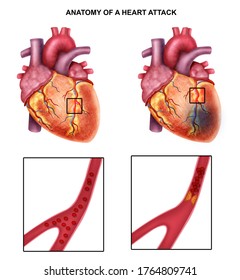 Medical Illustration Human Heart Attack Stock Illustration 1764809741 ...