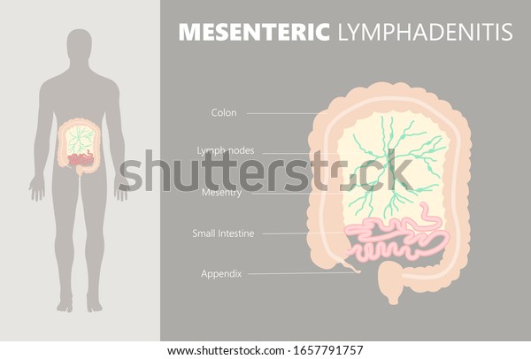Medical illustration of mesenteric\
lymphadenitis by inflamed lymph nodes in bowel membrane of \
mesentery abdominal wall. Abdominal pain viral infection from\
gastroenteritis diagram\
illustration.