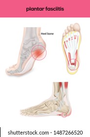 
Medical Illustration Of Plantar Fasciitis