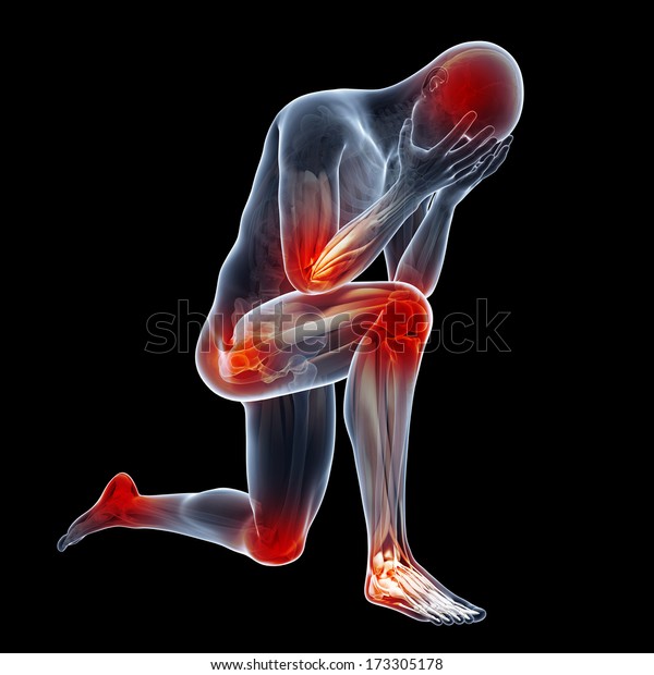 炎症を起こし痛みを伴う関節を示す医療イラスト のイラスト素材
