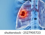 Medical Illustration showing lung cancer or bronchial carcinoma. 3d illustration