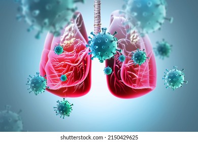 Medical Illustration Showing Lung Cancer Bronchial Stock Illustration ...