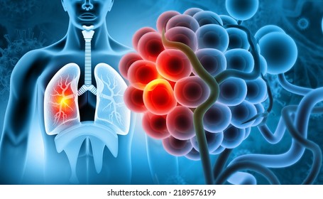 Medical Illustration Showing Lung Cancer Bronchial Stock Illustration ...