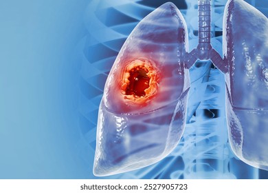 Medical Illustration showing lung cancer or bronchial carcinoma. 3d illustration