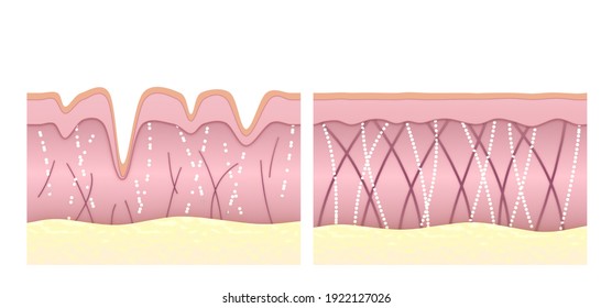 Medical illustration showing skin tissue cross-section. Comparison collagen and elastin fibers in smooth young and aging wrinkled skin. 