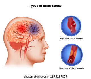   Medical illustration Types of Brain Stroke