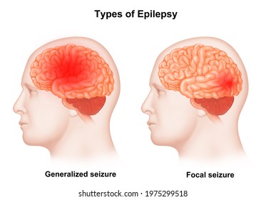 Medical illustration Types of epilepsy