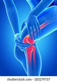 Medical Illustration - Woman Having Pain In The Knee