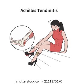 Medical Illustration Of A Woman Suffering From Achilles Tendinitis In High Heels