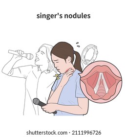 
Medical Illustration Of A Woman Who Has Difficulty Singing Due To Vocal Nodule