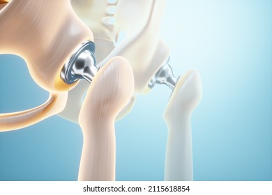 Medical Poster Image Of A Hip Implant. Artificial Joint, Arthritis, Inflammation, Fracture, Cartilage. 3D Illustration, 3D Render