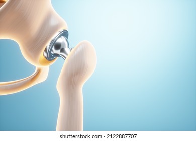 Medical poster image of a hip implant. artificial joint, Arthritis, inflammation, fracture, cartilage. 3D illustration, 3D render